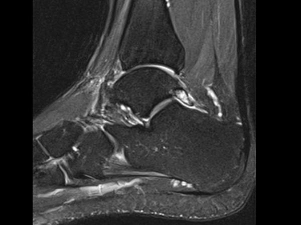 os-trigonum-syndrome-mri-captions-update-trendy